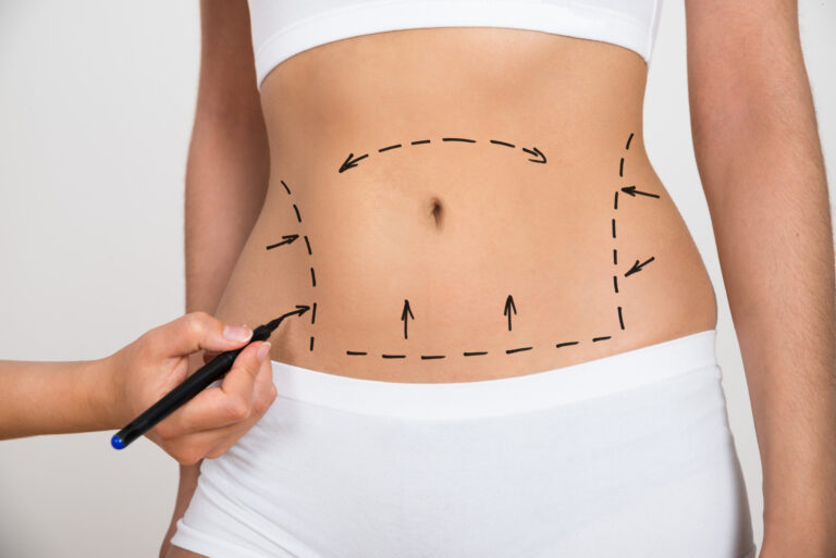 What Is the Cost of an Abdominoplasty?