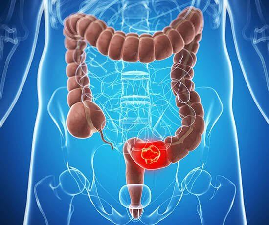 Understanding Colon Cancer Treatment and the Services from Global Top Centers