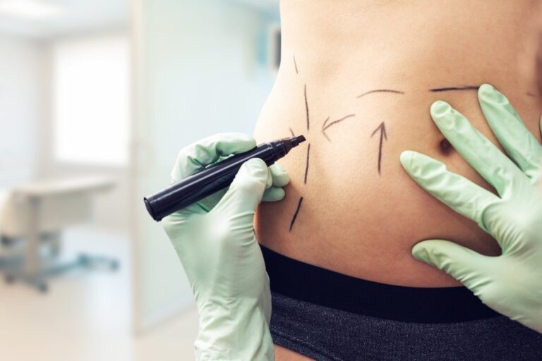 How Much Does a Tummy Tuck Cost? 3 Things to Know