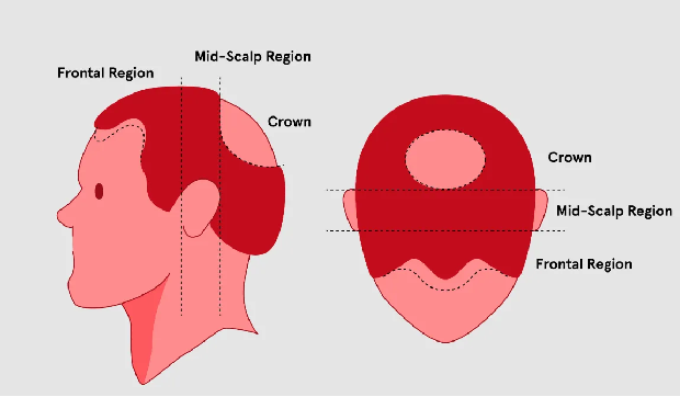 Where Is Crown of Head and How to Fix the Crown Hair Loss?