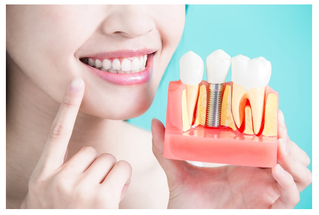 Best Dentist in Turkey for Implants: Your Path to a Flawless Smile with Aqua Dental Clinic