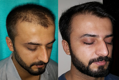 hair transplant before after