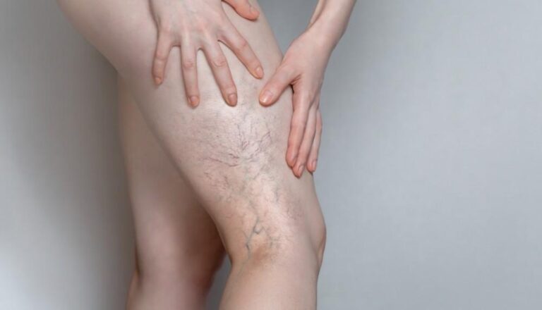 Why Does Vein Disease Happen and How to Treat It