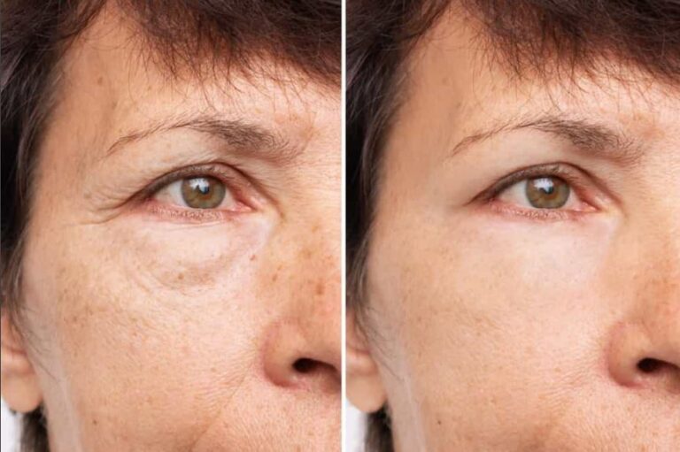 Tear Trough Treatment: Erase Years from Your Appearance