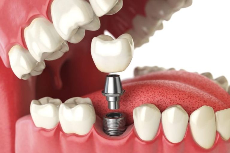 Understanding the Different Types of Dental Crowns: A Guide for Brampton Patients
