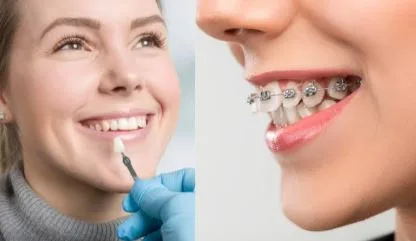 Smile Makeovers: Integrating Veneers with Orthodontic Treatments for Aesthetic and Functional Perfection