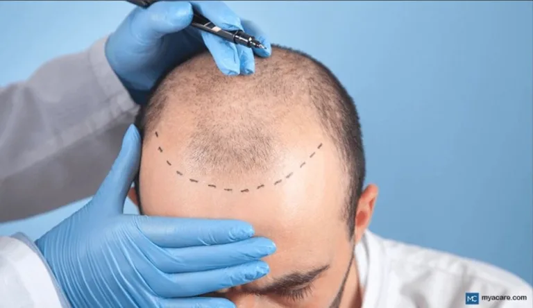 Robotic Hair Transplantation: The Future of Hair Restoration