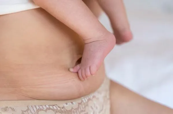 How Tummy Tuck Improves Post-Pregnancy Body Shape