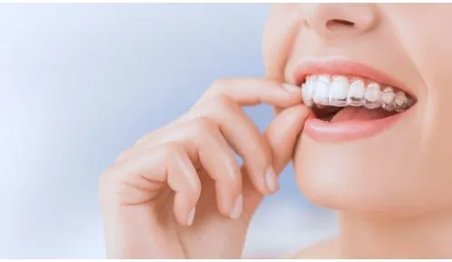 5 Pro Hygiene Hacks Every Clear Aligner Wearer Must Know