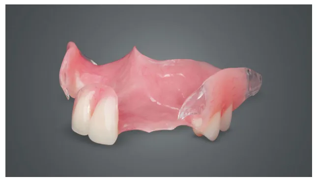 Why Flipper Teeth and Essix with Pontic Are Still a Smart Choice