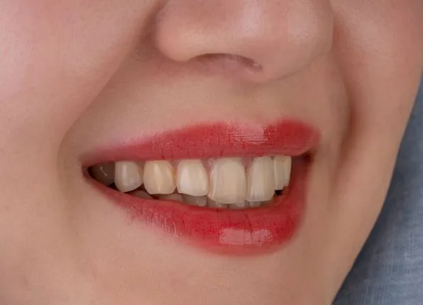How Orthodontic Treatment Can Improve Your Smile and Oral Health