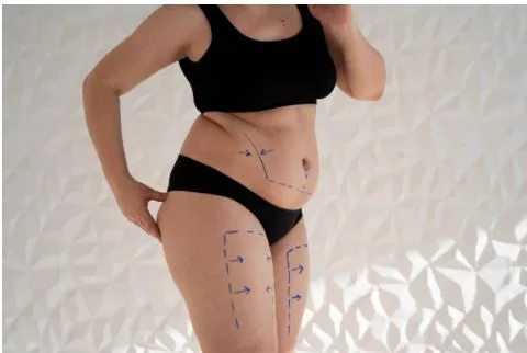 BBL Miami: Latin American Patient Guide & Safety Tips