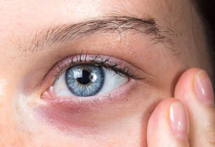 Dark Circle Treatment: Effective Solutions for Brighter, Healthier Eyes