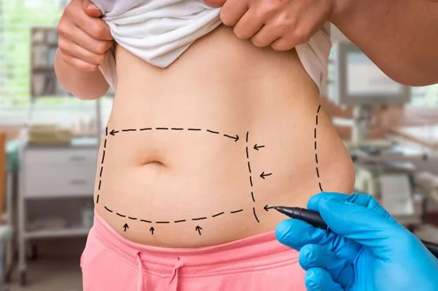 Liposuction in Dubai: Cost, Recovery, Results, and Treatment Options