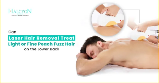 Can Laser Hair Removal Treat Light or Fine Peach Fuzz Hair on the Lower Back?