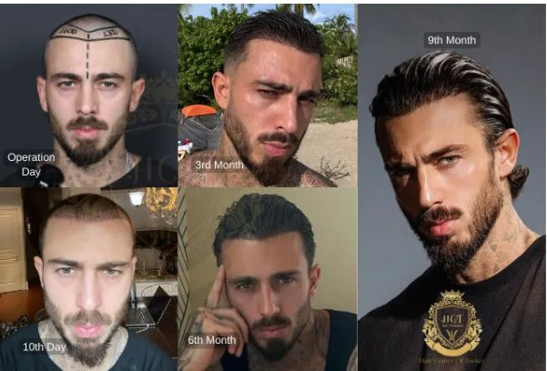 10 Important Factors to Consider When Choosing a Hair Transplant Clinics in Turkey