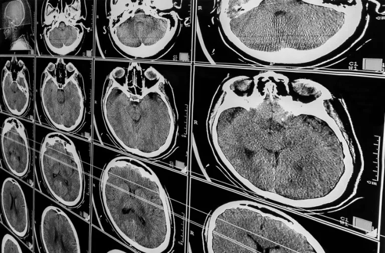 What Most People Miss When They Think a Brain Injury Case Is Simple