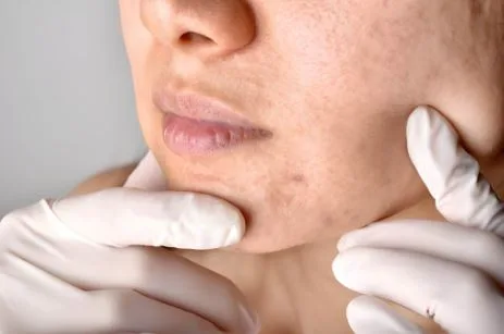 How to Remove Dark Spots on Face