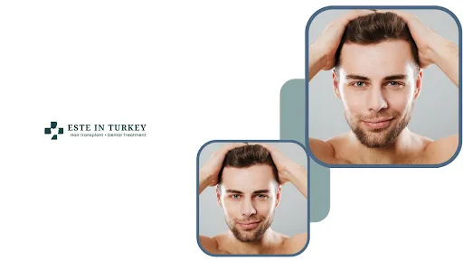 FUE Hair Transplant Turkey How The Sapphire Technique Works Step By Step