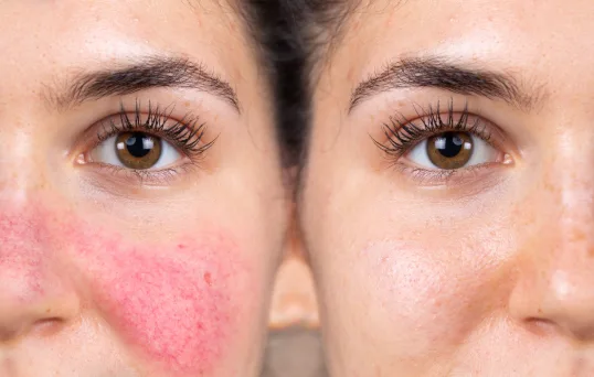 What to Do If a Cosmetic Treatment Area Becomes Red, Hot, or Painful