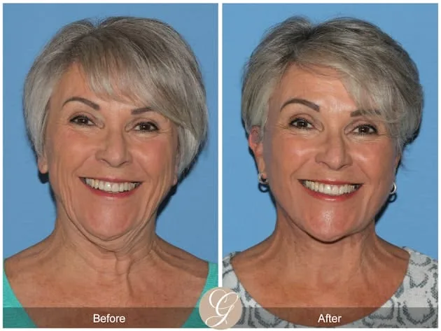Is a Deep Plane Facelift Right for You? A Surgeon’s Guide